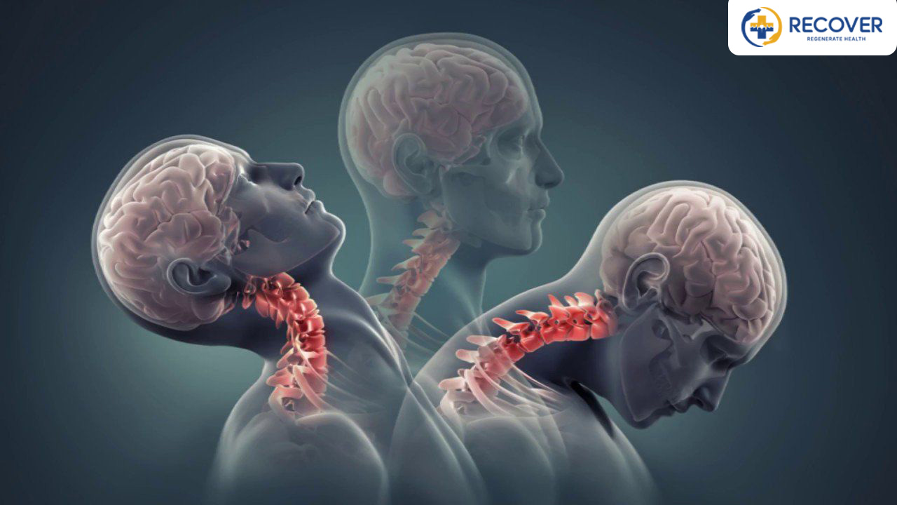 Thoái hóa đốt sống cổ là gì